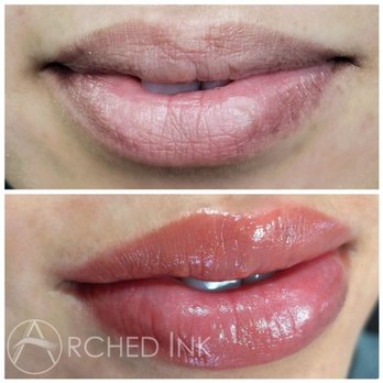 Lip correction